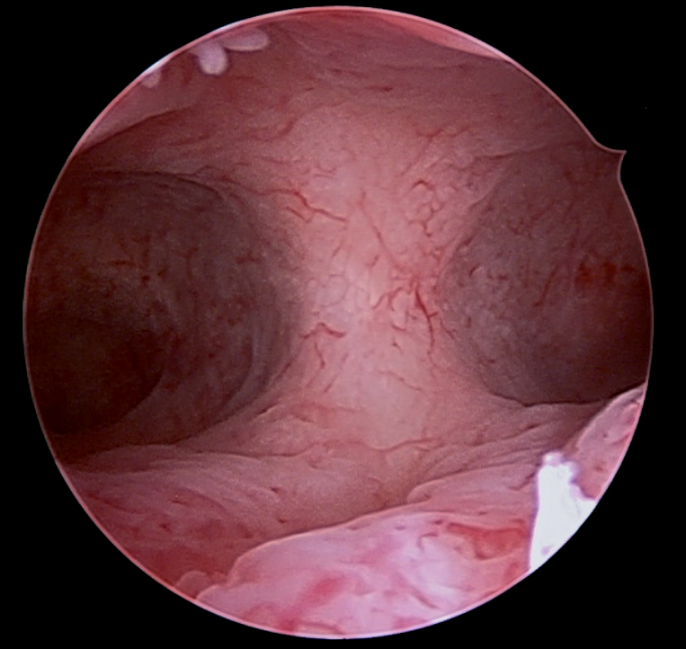 Fig. 9. Septo uterino
